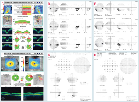 This patient has superior rim thinning with correlating RNFL loss on OCT testing (C and D). This corresponds to associated inferior paracentral and nasal visual field defects with variable central defects in both eyes (D and E). Due to these borderline defects and the spatially correlating ganglion cell complex thinning in the left eye (F), central 10-2 visual field testing better documented the breadth and depth of these defects (G and H).