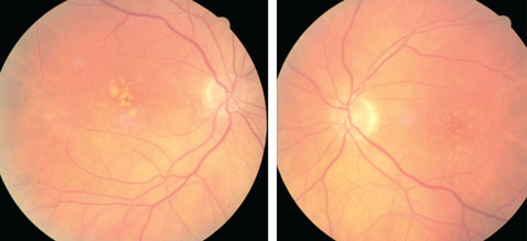 At left, this eye qualifies as intermediate AMD per the AREDS classification system. At right, the patient qualifies as intermediate AMD and is progressing to the advanced stage due to the pigment clumping centrally. Photo: Julie Poteet, OD.