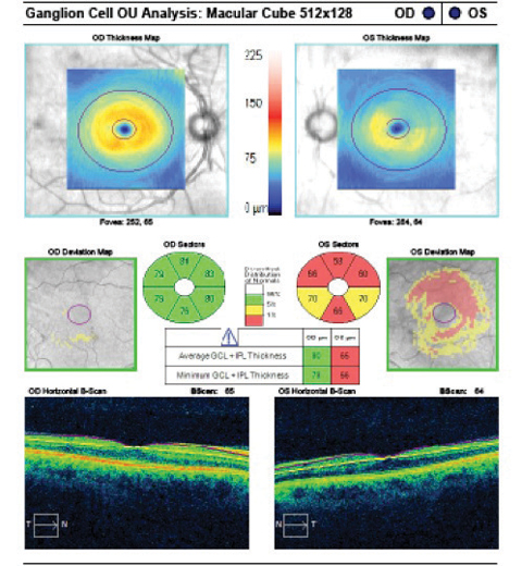 Fig. 2. The GCA shows significant asymmetry in both the average and minimum thickness. Depressions in the RGC-inner plexiform layer thickness are illustrated in all sectors OS, greatest superiorly, correlating with the RNFL findings OS.