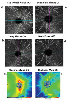 Fig. 4. The superficial and deep capillary plexus segmentation of the OD and OS show significant asymmetry in the peripapillary capillary densities OD>OS (a and b, c and d, respectively). This asymmetry is most evident in the superficial capillary plexus OS. Images (e and f) depict significant thickness asymmetry OD>OS. 