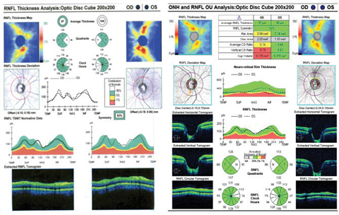 Fig. 2. Although there is a slit defect inferiorly, the RNFL analysis still interpreted this area as normal compared with the normative data. The OCT RNFL also depicts inferior temporal RNFL thinning on the deviation map and clock hour map OD compared with the normative data.