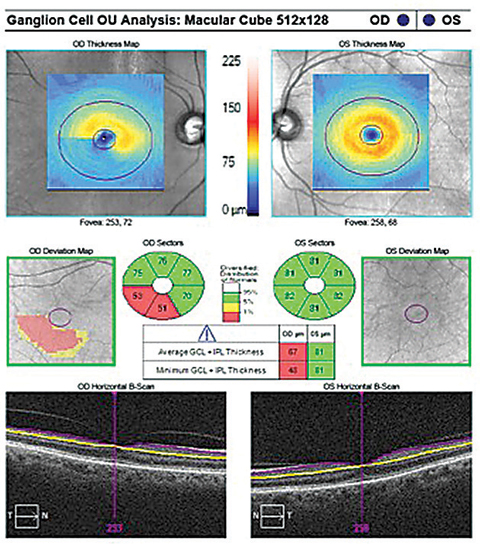 Fig. 6. The GCA illustrates inferior temporal sector RGC-IPL thinning OD correlating to the clock hour thinning of the OCT RNFL OD.