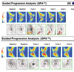 Fig. 7. Serial OCT RNFL progression analysis shows progressive RNFL thinning inferior temporally OD over successive exams compared with baseline one and two. No RNFL thinning is noted OS over six exams compared with normative data. 