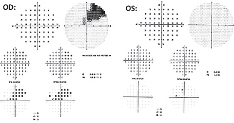 Fig. 5. A 10-2 central visual field was ordered to further investigate the 24-2 structural findings OD. It depicts a dense cluster superior/superior nasal to fixation correlating to the inferior temporal ganglion cell/inner plexiform thinning noted on GCA OD.