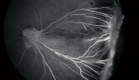 Fig. 3. Close-up of the left eye FA at initial presentation.