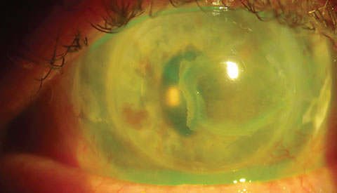 Recurrence of BK in seeing left eye of same patient. This eye with ACIOL and penetrating keratoplasty for band keratopathy had recurrence despite efforts to address systemic causes (patient discontinued vitamin D).  