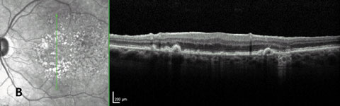 Fig. 5b. GA confirmed with OCT showing increased transmission through to the choroid in region of GA.