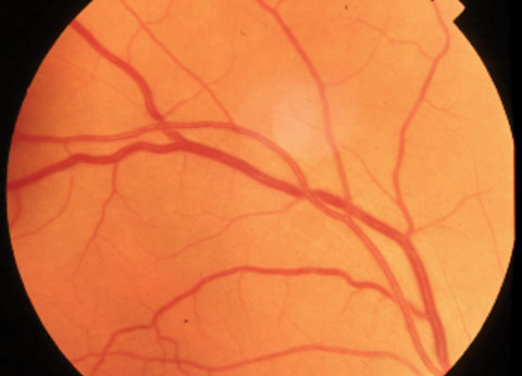 Arterial attenuation and arteriovenous nicking in hypertension.