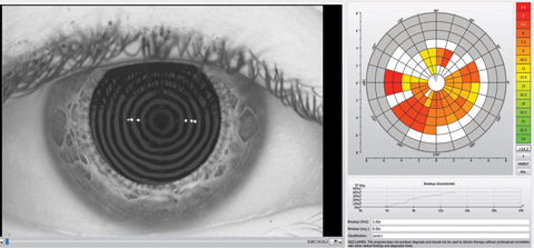 This patient, a 27-year-old female, displayed an abnormal tear break-up time.