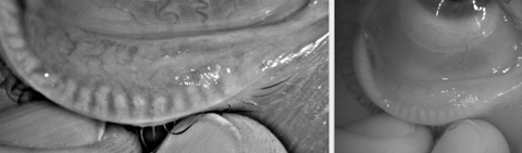 This patient displays significant gland atrophy.