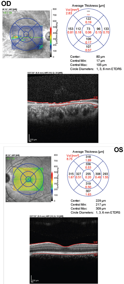 Fig. 2. This OCT of the macula of the right eye (above) shows severe atrophy of both inner and outer retina. The OCT of macula of the left shows a normal foveal contour.  