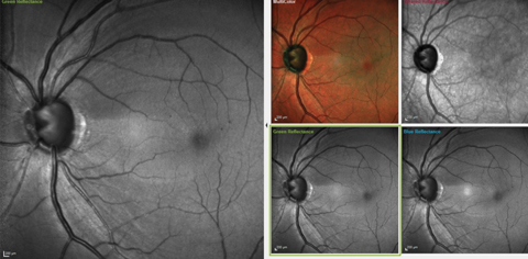 Fig. 1. These images show the significant RNFL wedge defect located between the one and two o’clock positions, as well as a diffuse RNFL loss in the four to five o’clock positions. Microaneurysms are also visible perifoveally.