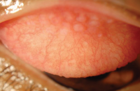 Fig. 2. Contact lens-related papillary conjunctivitis while wearing silicone hydrogel. Photo: Christina Newman, OD