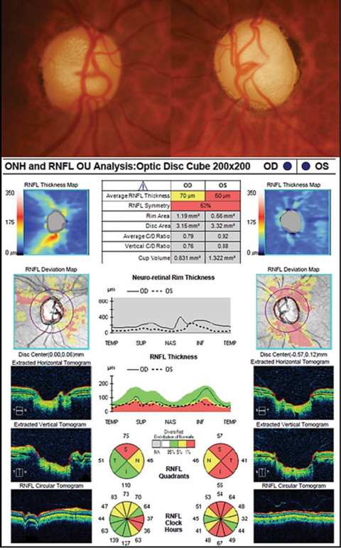 Fundus photos and OCT images of our 56-year-old glaucoma patient.