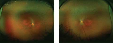 This 19-year-old patient, diagnosed with LCA at six months of age, has attenuated arterioles and bone-spicule pigmentation in the mid-periphery of both eyes. Photos: Sherry J. Bass, OD