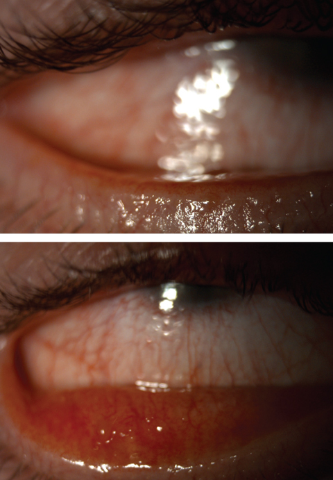 Fig. 3. Severe meibomian gland dysfunction with telangiectatic vessels. 