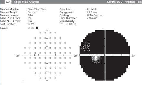 Visual fields like this from an end stage glaucoma patient show the lack of function we’re hoping neuroprotective advancements can halt. 