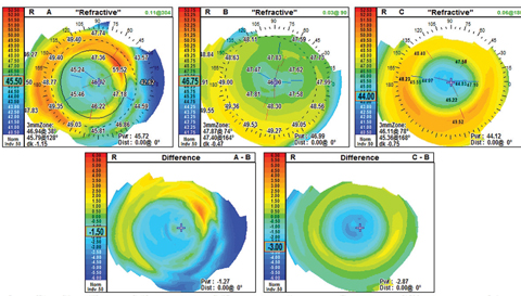 Fig 1. The refractive difference map shows the similar corneal power profile for multifocal soft lenses and corneal reshaping. In map A, the patient is wearing NaturalVue multifocal 1-day -3.00. Map B is the naked cornea, and map C is the same patient after a night of corneal reshaping treatment. 