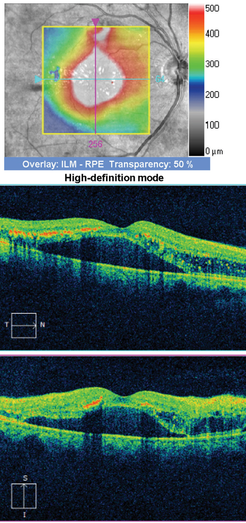 Fig. 3. SD-OCT of our patient’s right eye.