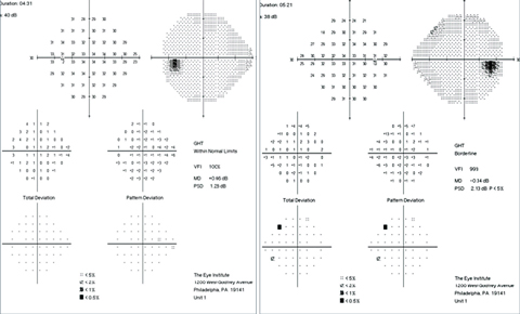 Case 1. This 51-year-old woman presented with a complaint of daily right-sided head and eye pain, as well as worse vision in the right eye. Her VFs were normal with no RAPD. All other aspects of her afferent and efferent visual function were intact. Despite wearing progressive lenses, her vision was reduced more so at near than at distance in the right eye compared with the left eye. Careful refraction found that she was over-minused by 1.00D in the right eye. With the new prescription trial-framed, she felt her eyes were more relaxed and her vision was comfortable and symmetric.