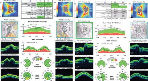 Cases 3 and 4. Both of these patients demonstrate optic disc elevation as evidenced by a thick neuroretinal rim OU. However, the patient on the right is more concerning for papilledema due to the inferior RNFL thickening, as opposed to the temporal RNFL thickening in the patient on the left. In papilledema, the area of the disc that swells first is the one with the most nerve fibers, which is inferior. Since the thickness of the neuroretinal rim often follows the ISNT rule, it would be unlikely to have only the temporal RNFL thicker than normal in papilledema. 