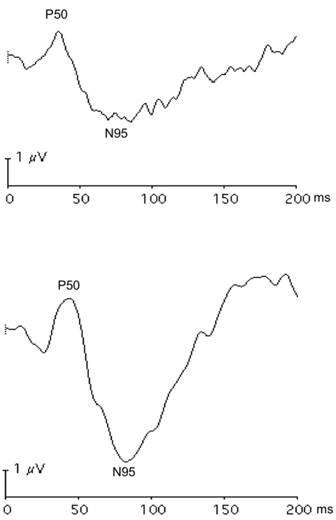 Fig. 8. These pattern ERG responses of the right (A) and left (B) eyes in a patient with bilateral asymmetric optic nerve hypoplasia show lower amplitude of the N95 component in the right eye with more severe optic nerve deficit.