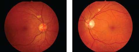 Fig. 2. This cotton wool spot superior to the optic nerve in the right and left eye of a 38-year-old asymptomatic female patient led us to order testing, which revealed a diagnosis of anemia.