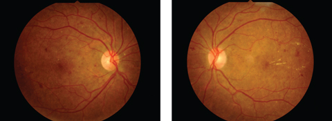 Fig. 3. This 56-year-old male’s fundus images indicate the presence of hemorrhaging and exudates associated with diabetic retinopathy.