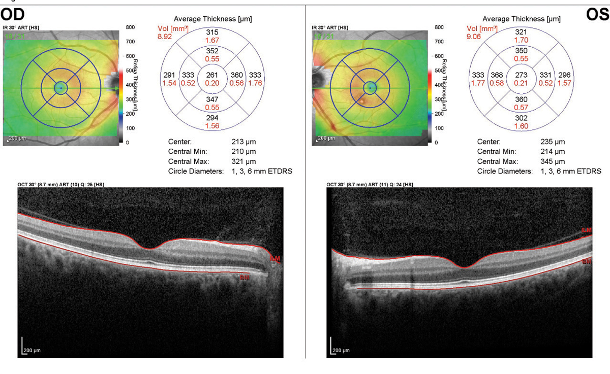 This SD-OCT of a patient taking 400mg of Plaquenil daily shows no signs of maculopathy, as each eye’s inner/outer segment line is intact.