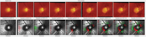 HRT 3 imaging shows a distinct change in the IT neuroretinal rim of our patient’s right eye, first noted in 2015.