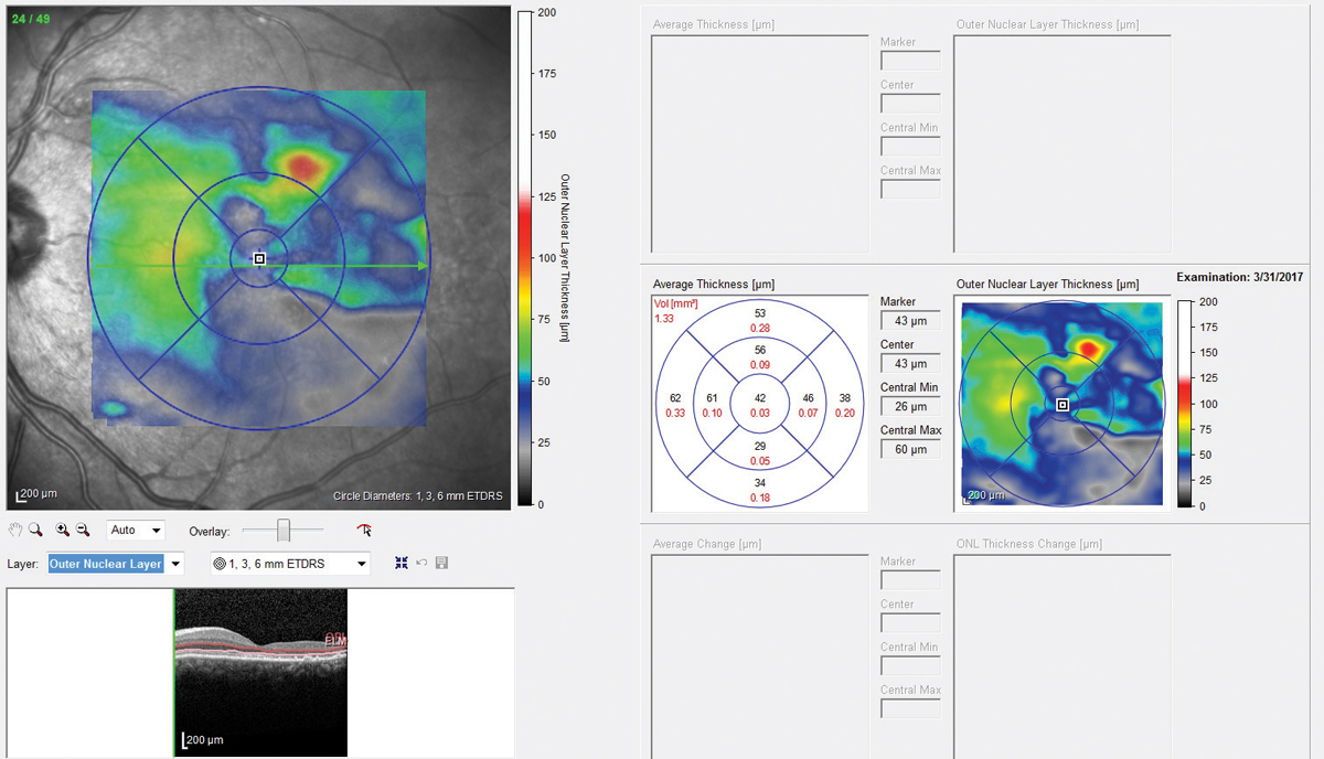 Fig. 6. A retinal thickness map of the eye illustrated extensive areas of outer nuclear layer atrophy.