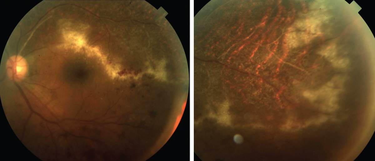 Fig. 1. Along with the “ketchup and cottage cheese” appearance, CMV may advance like a “brush fire” or the tip of an ocean wave, leaving a necrotic retina. 