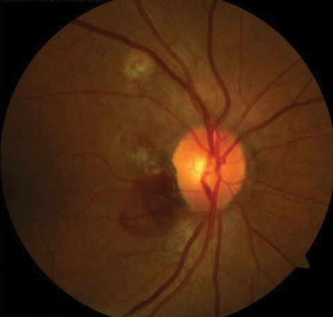 Fig. 1. PCV signifies subretinal bleeding.