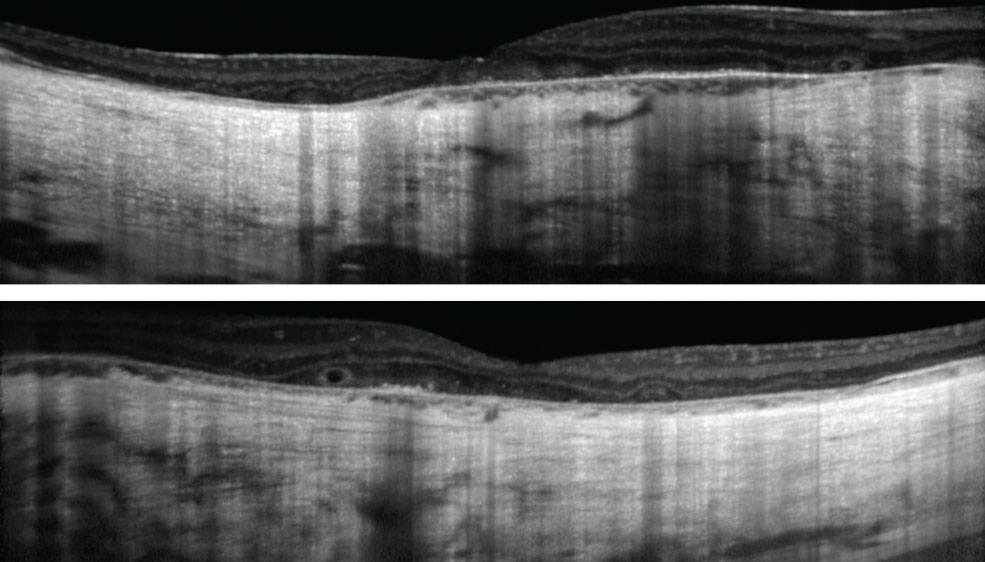 Fig. 2. These OCT images show our patient’s right, at top, and left eyes. The patient has had visual complaints since childhood.