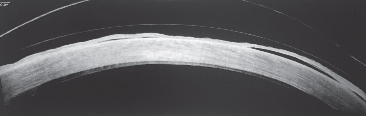 g. 3. This OCT evaluation of a scleral contact lens in a patient reveals a significant epithelial defect.