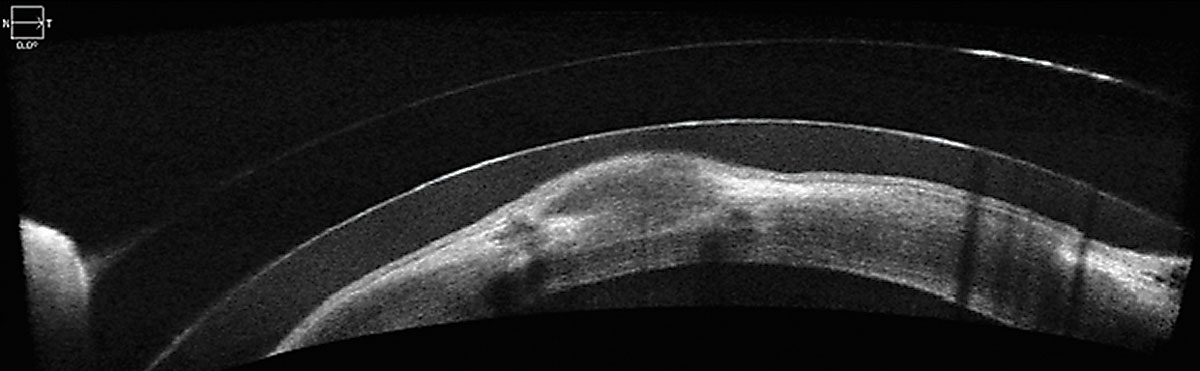 Fig. 5. Evaluating a scleral contact lens fit with OCT reveals clearance over the edematous graft-host junction.