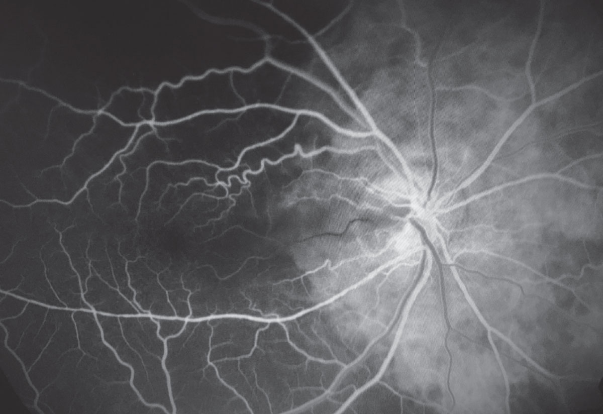 This fluorescein angiography of a GCA patient shows choroidal ischemia temporally, optic nerve leakage and cilioretinal artery occlusion. 