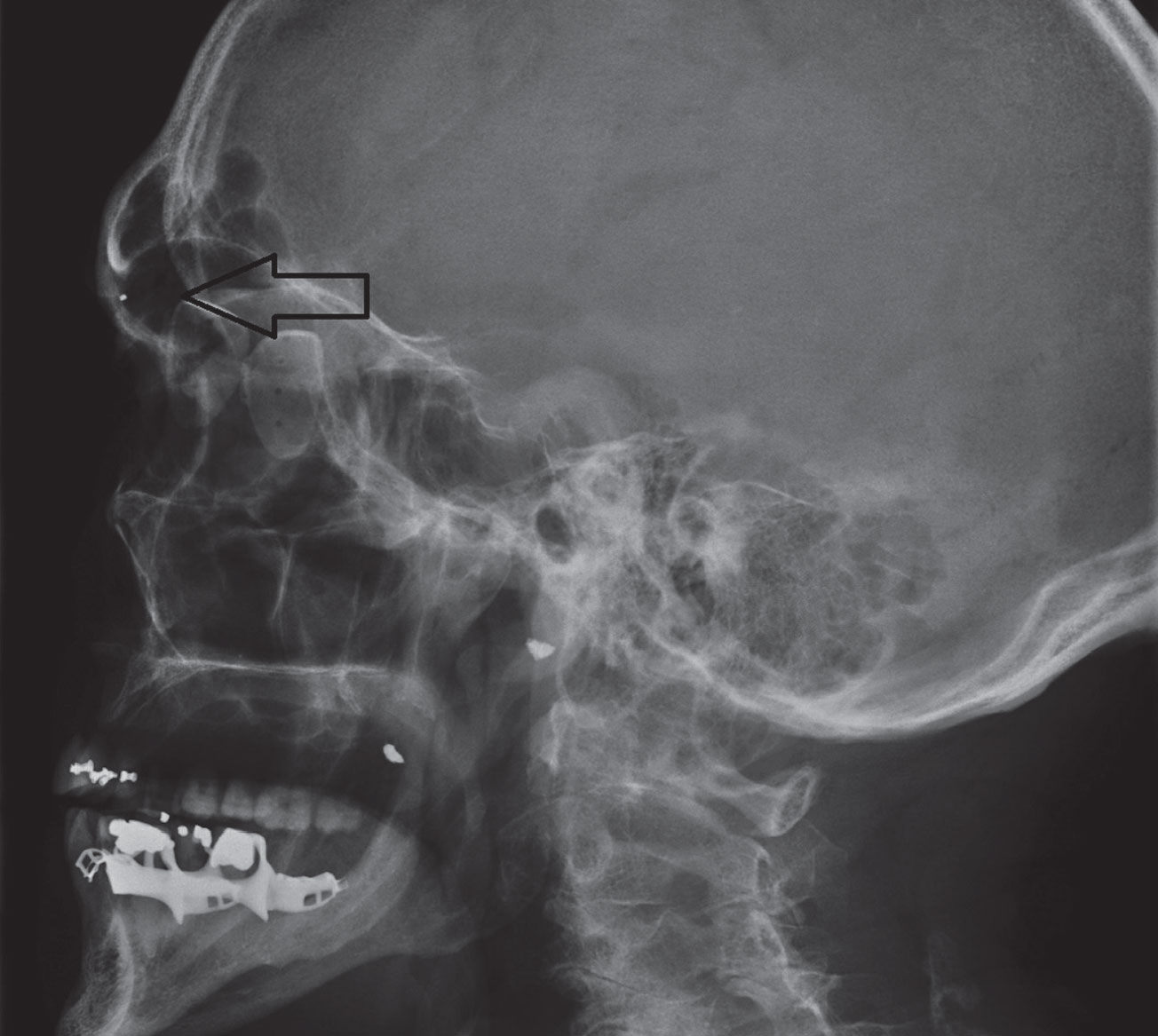 These radiographic x-ray sagittal images demonstrate two small metallic shrapnel fragments overlying the right mandible and a smaller shrapnel fragment within the left orbit.