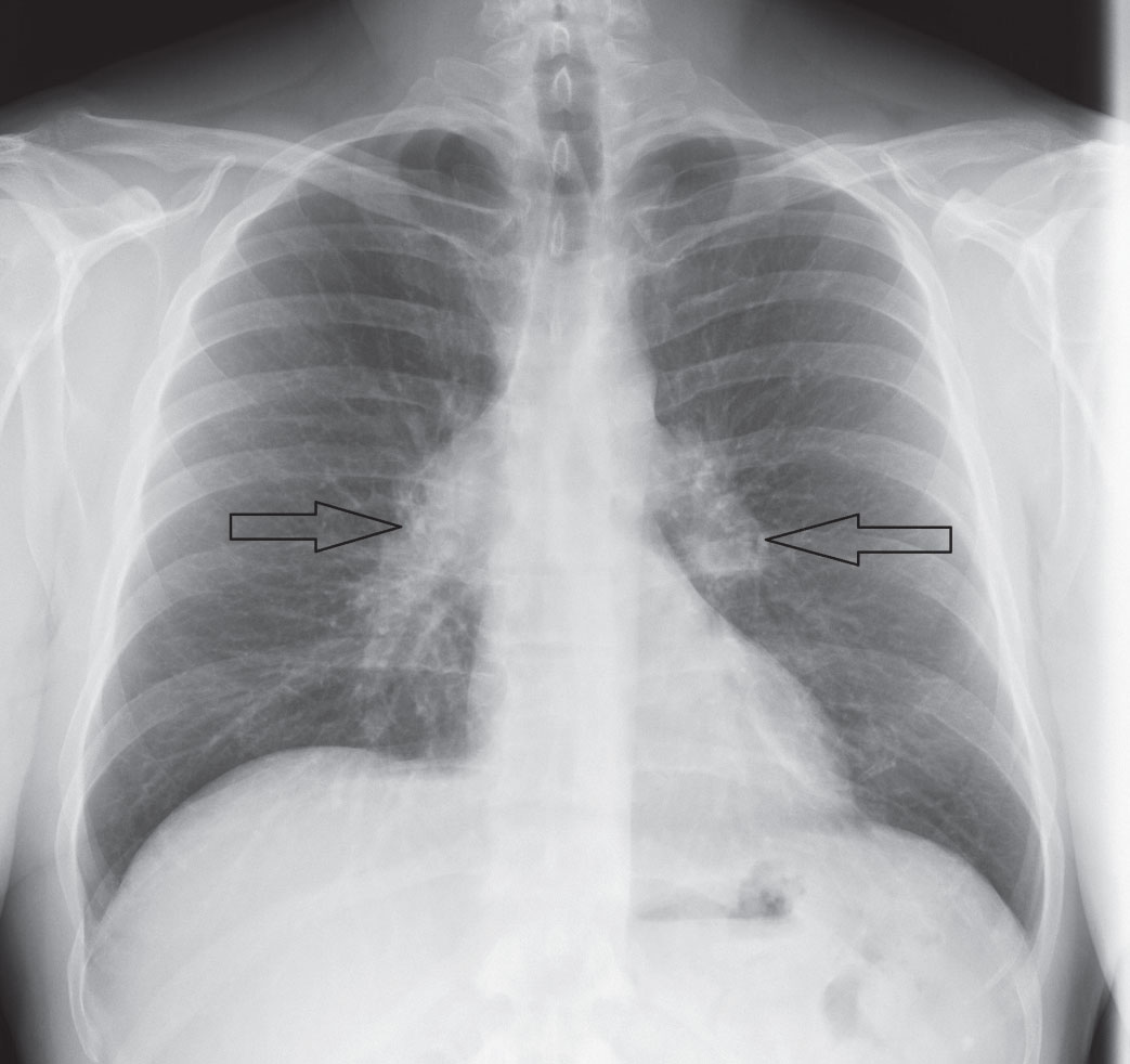 A Chest X Ray Bilateral Hilar Lymphadenopathy B C Ct 