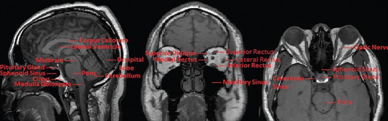 Fig. 6. This figure shows normal MRI T1W images in (left to right) sagittal, coronal and axial cuts. Some major anatomic landmarks are indicated in red.