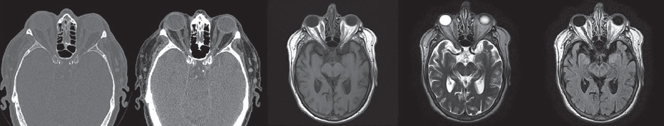 Fig. 7. This patient has thyroid eye disease, including proptosis OD>OS, secondary exposure keratopathy, extraocular muscle movement restrictions and diplopia. He has no clinical or radiologic evidence of optic nerve compression. Imaging includes (left to right, all axial cuts) CT with bone windows, standard CT, MRI T1W, MRI T2W and MRI FLAIR sequence. They reveal proptosis OD>OS, enlarged extraocular muscle bellies and mild prominence of the intraconal fat bilaterally.