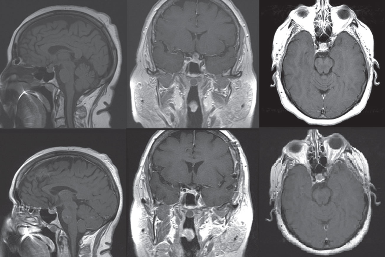 Fig. 8. This patient had a pituitary macroadenoma, which was resected via left pterional craniotomy. Preoperative (above) and postoperative (below) MRI T1W imaging shows (left to right) sagittal, coronal and axial cuts. Preoperatively, notice the pituitary fossa with a heterogeneously enhancing and enlarged pituitary extending to the left optic chiasm, which was displacing the left optic nerve’s course superiorly. Postoperatively, notice the hypo-enhancement in the sella turcica and removal of the suprasellar component of the pituitary lesion with minimal residual soft tissue and the decrease in the left optic nerve and chiasmal mass effect. The MRI images also show post-surgical encephalomalacia/gliosis in the opercular region of the left frontal lobe and in the anterior left temporal lobe, subadjacent to a left pterional craniotomy defect.