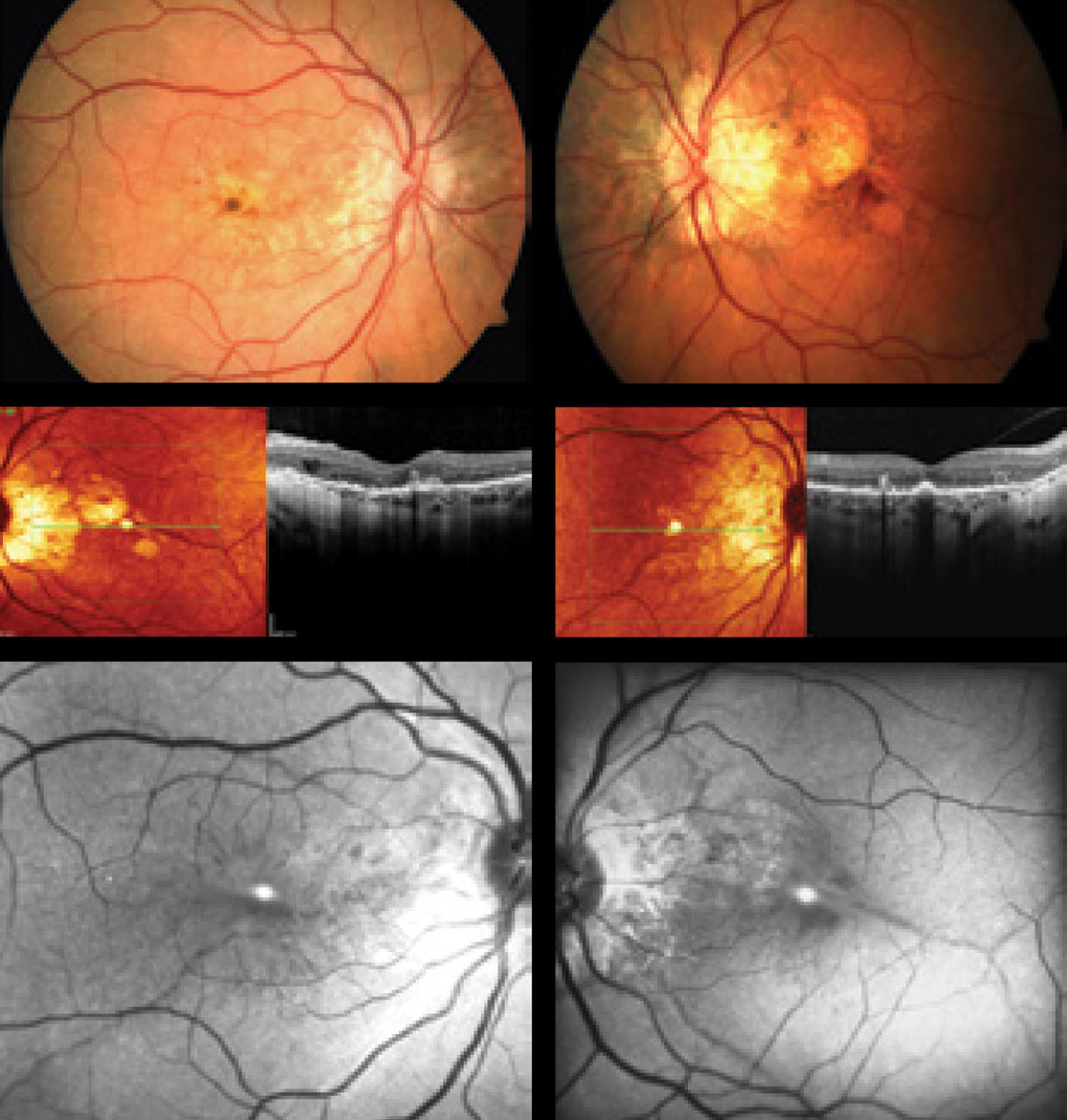 How can this 52-year-old patient’s posterior segment findings help explain her five months of blurry vision?