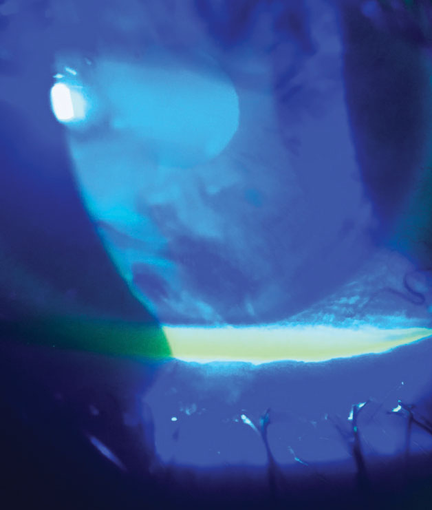 Fig. 3. Reduction in tear break-up time is easily assessed and has direct correlation to CLD.