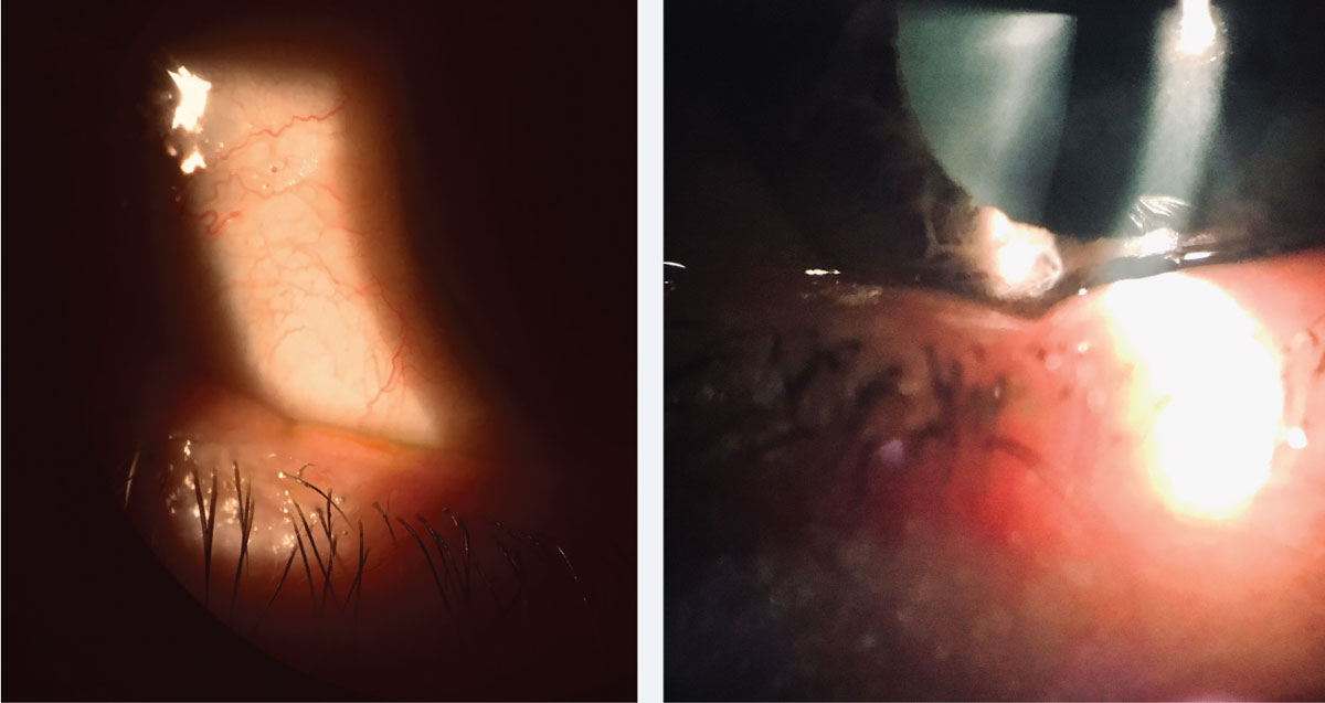 Fig. 2. Lid notching indicating MGD is easily overlooked and can be a clue to underlying deficient lipid tear film layer. 