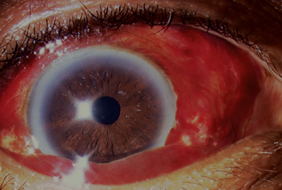 Fig. 4. Ocular lubricants were required in this case due to the bullous nature of the subconjunctival hemorrhage, which caused corneal damage.