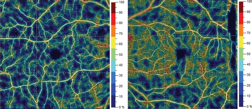 Fig. 3. Color map representation of superficial vessel density percentages OD (left) versus OS (right). Comparative grid-based vessel density between the eyes varied from 2% to 15%. 