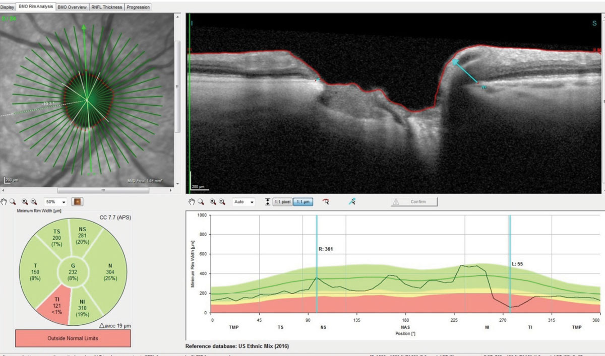 This radial set of OCT scans through the right optic nerve demonstrate marked thinning of Bruch’s membrane opening. Note the significant loss of ganglion cells in the inferotemporal rim and a thickness reading of only 55μm in the highlighted scan.