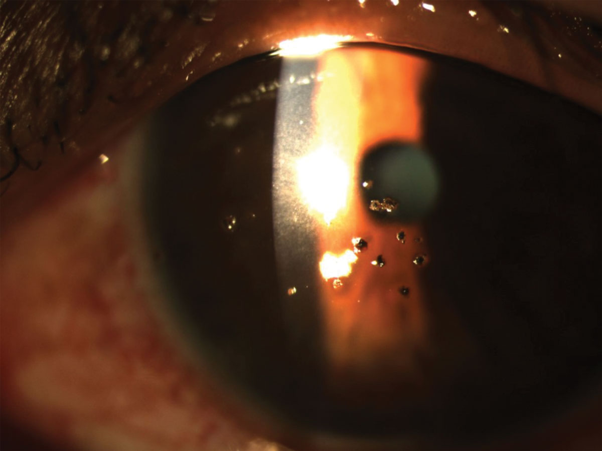 foreign body in eye
