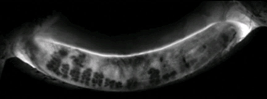 This Lipiscan image of a patient’s meibomian glands shows extensive areas of gland loss and truncation consistent with the patient’s complaints of dry eye. 